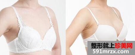 郑州自体脂肪丰胸多少钱、自体脂肪移植丰胸价格