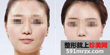合肥吸脂瘦脸多少钱、面部吸脂价格