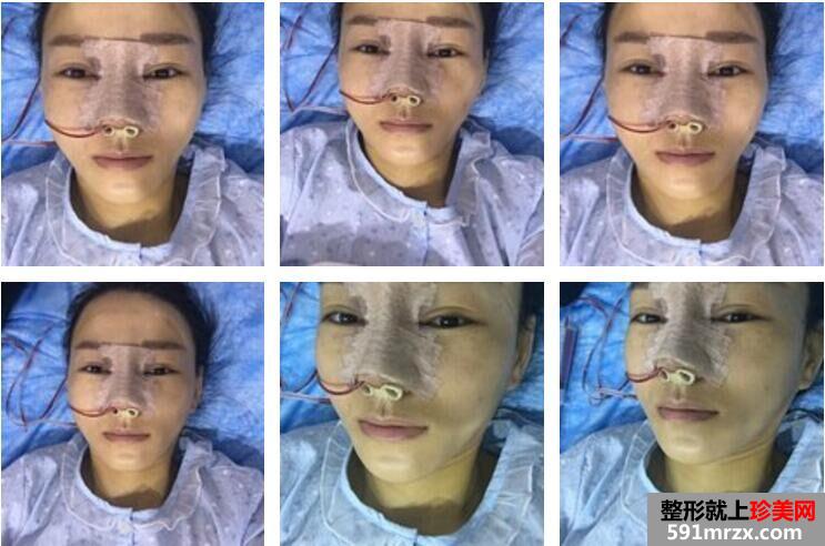 韩式生科假体隆鼻+垫鼻尖术后鼻子超好看