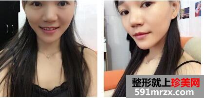 韩式生科假体隆鼻+垫鼻尖术后鼻子超好看