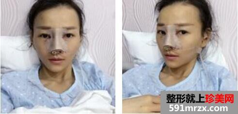 韩式生科假体隆鼻+垫鼻尖术后鼻子超好看