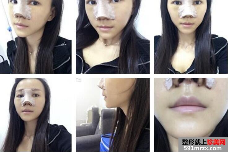 韩式生科假体隆鼻+垫鼻尖术后鼻子超好看