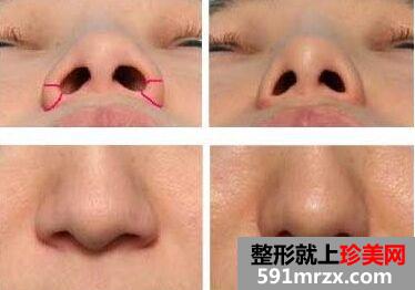 南昌鼻翼缩小手术价格、缩小鼻翼多少钱