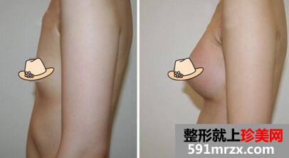 宁波假体丰胸价格、假体隆胸手术多少钱