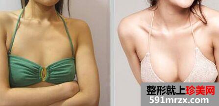 沈阳自体脂肪移植丰胸价格多少 