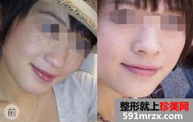 南宁激光治疗雀斑多少钱、激光祛雀斑价格