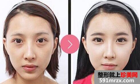 无锡自体脂肪面部填充多少钱