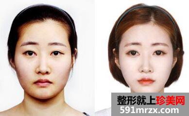 南宁美白针多少钱、美白针真的有效吗
