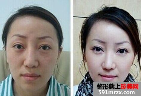 南昌水光针多少钱一针、水光针效果好吗