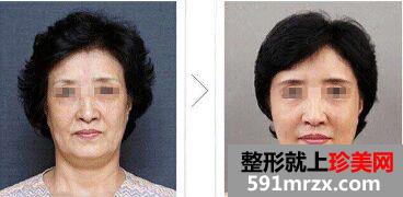 天津射频除皱价格、射频除皱对比图