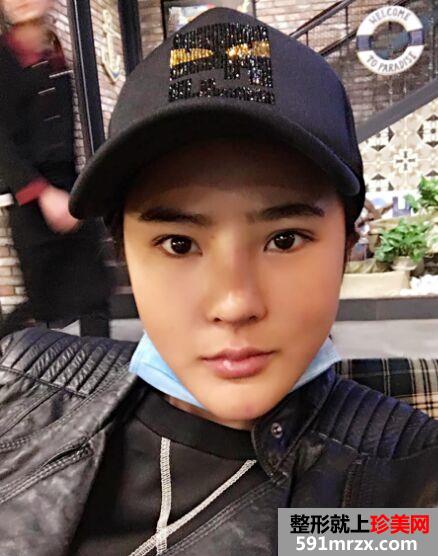 隆鼻失败后做了鼻综合 终于达到自己理想的鼻形