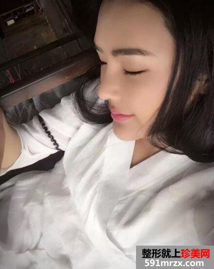 隆鼻失败后做了鼻综合 终于达到自己理想的鼻形