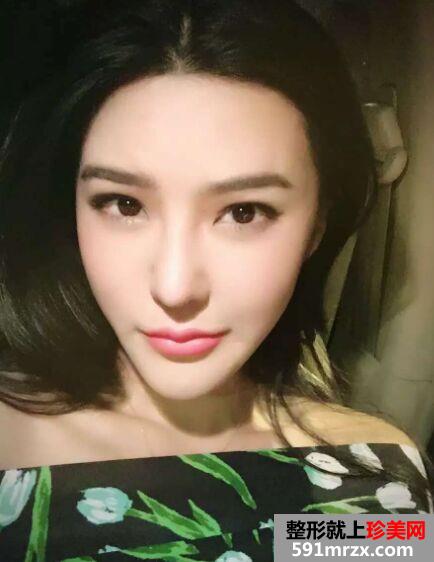 隆鼻失败后做了鼻综合 终于达到自己理想的鼻形