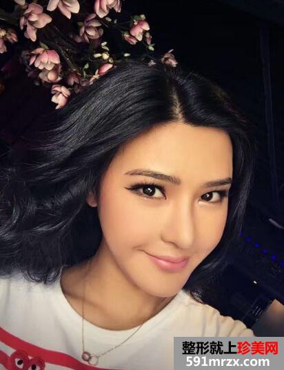 隆鼻失败后做了鼻综合 终于达到自己理想的鼻形