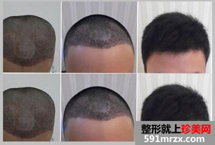 杭州植发大约多少钱、植发效果图