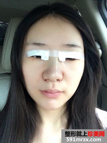 切开双眼皮+鼻子综合整形效果前后对比图