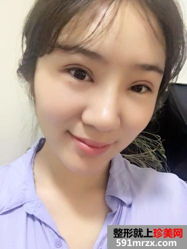 切开双眼皮+鼻子综合整形效果前后对比图