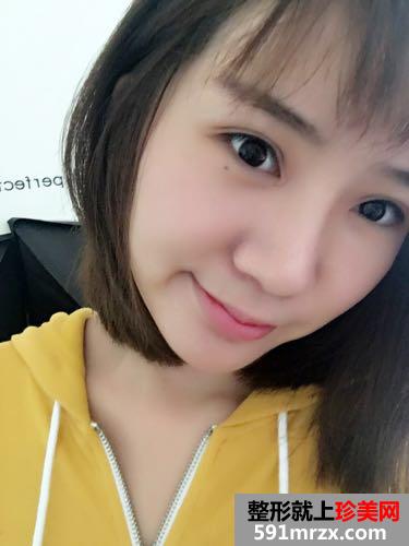 切开双眼皮+鼻子综合整形效果前后对比图