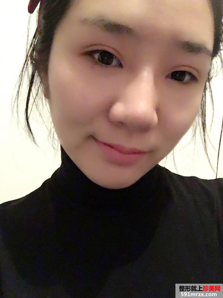 切开双眼皮+鼻子综合整形效果前后对比图
