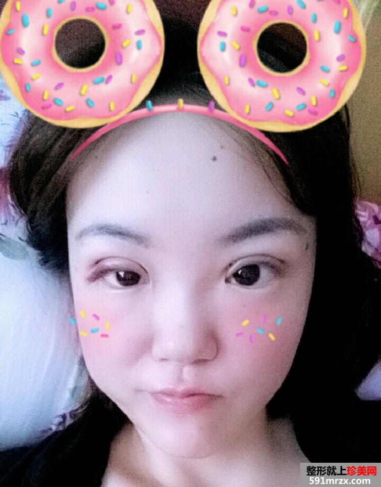 韩式三点双眼皮手术恢复过程对比照片