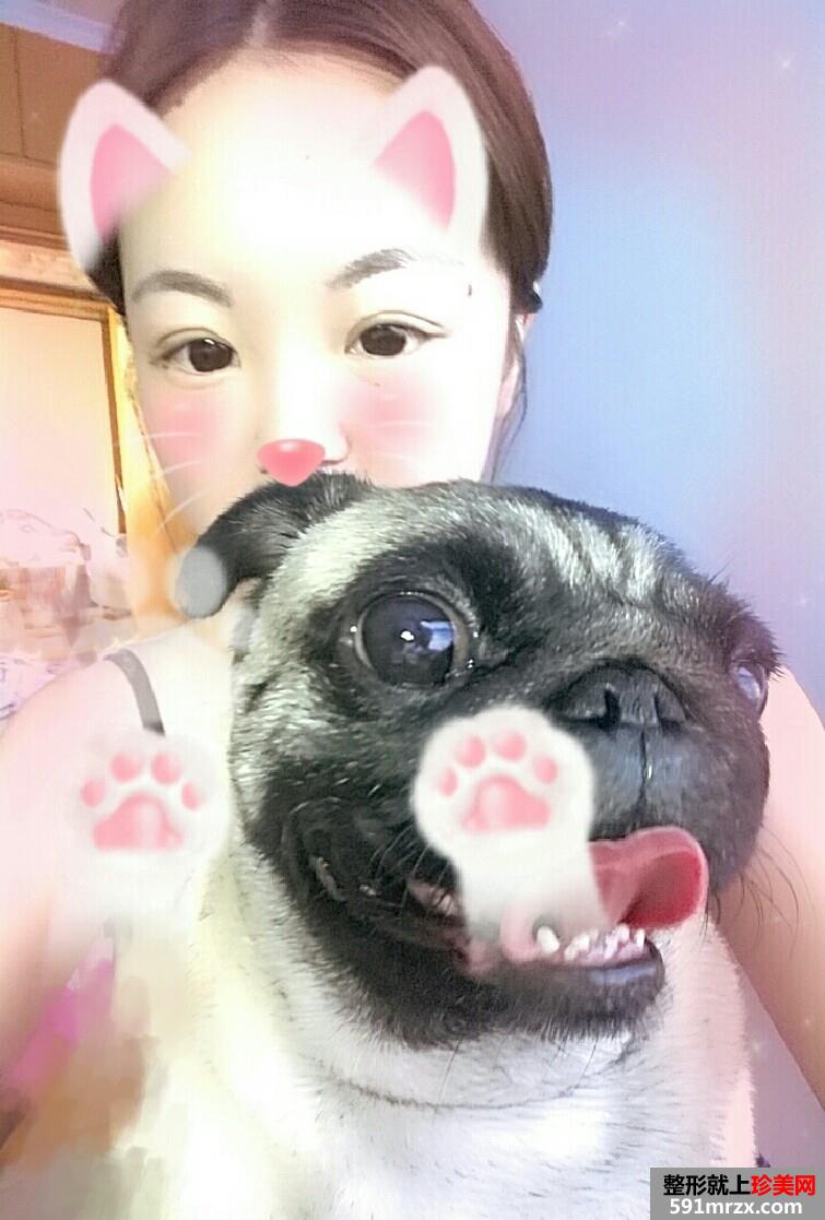 韩式三点双眼皮手术恢复过程对比照片
