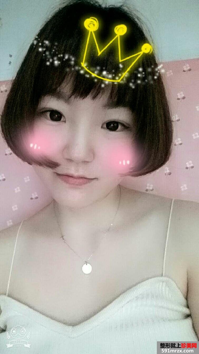 韩式三点双眼皮手术恢复过程对比照片