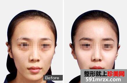 自体脂肪面部填充多少钱 自体脂肪填充面部价格