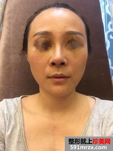 综合鼻整形60天恢复图片,亲身经历分享