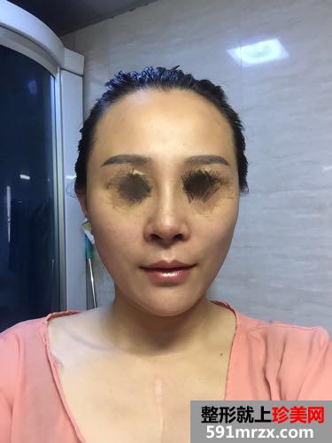 综合鼻整形60天恢复图片,亲身经历分享