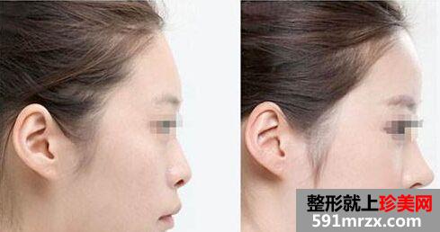 北京耳软骨隆鼻手术多少钱