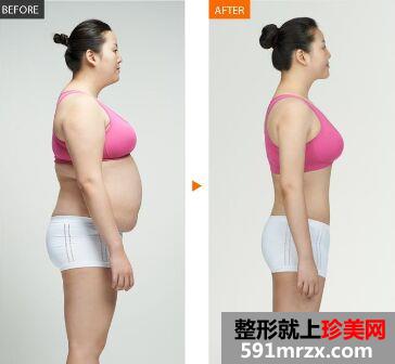 抽脂手术费用大概多少