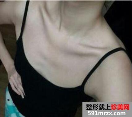 妙桃假体隆胸效果图真实案例过程分享