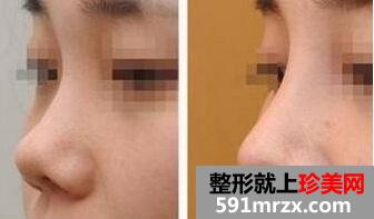 北京隆鼻子多少钱 北京隆鼻子价格影响因素