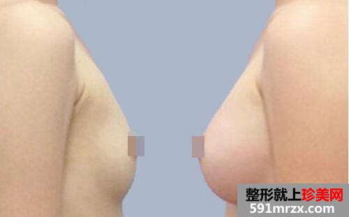 妙桃假体丰胸好不好、价格多少