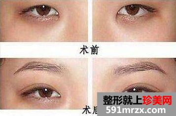 三点定位双眼皮一般多少钱