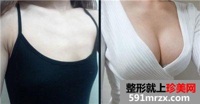 隆胸用麦格假体多少钱