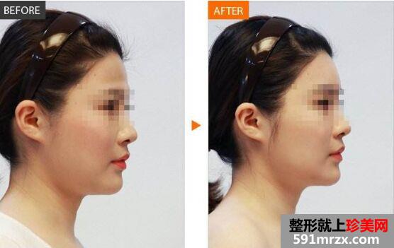 自体脂肪丰额头能维持多久，价格多少