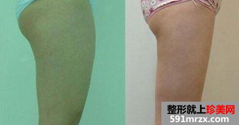 宁波瘦大腿吸脂价格大概多少钱