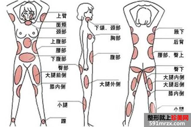 全身吸脂要多少钱 全身抽脂多长时间恢复