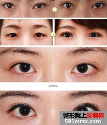 苏州双眼皮开眼角手术价格表