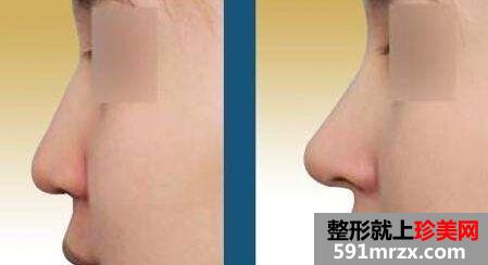 成都鼻整形价格表一览