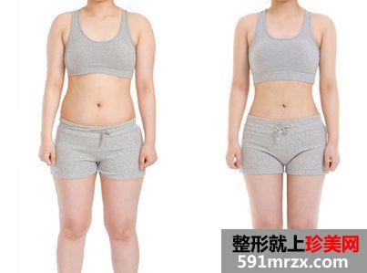 佛山吸脂减肥价格一览表