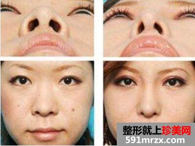 鼻翼缩小手术多少钱 鼻翼缩小对比照