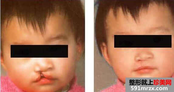 兔唇整形需要多少钱 唇腭裂整形修复图片