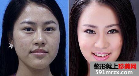 美白针真的能变白吗 全身美白针价格