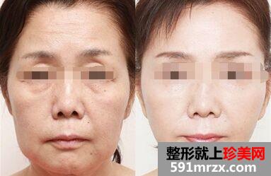 注射除皱有副作用吗 注射除皱需要多少钱