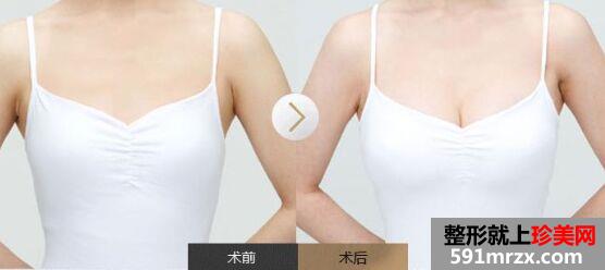 武汉丰胸多少钱 丰胸手术价格表一览