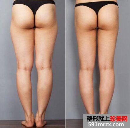 佛山吸脂减肥价格表 吸脂多少钱