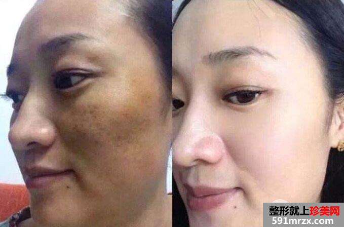 祛斑手术价格表|祛斑效果对比图