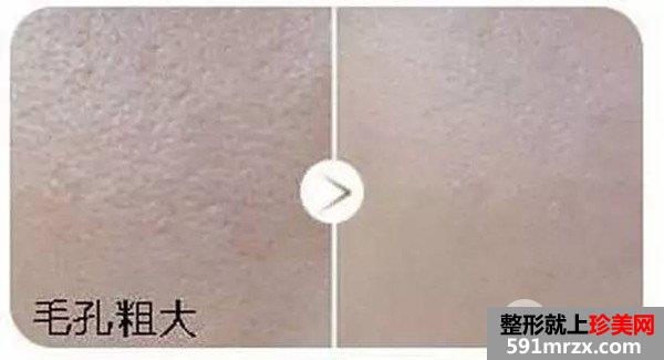 毛孔粗有黑头怎么办，彩光嫩肤一般多少钱
